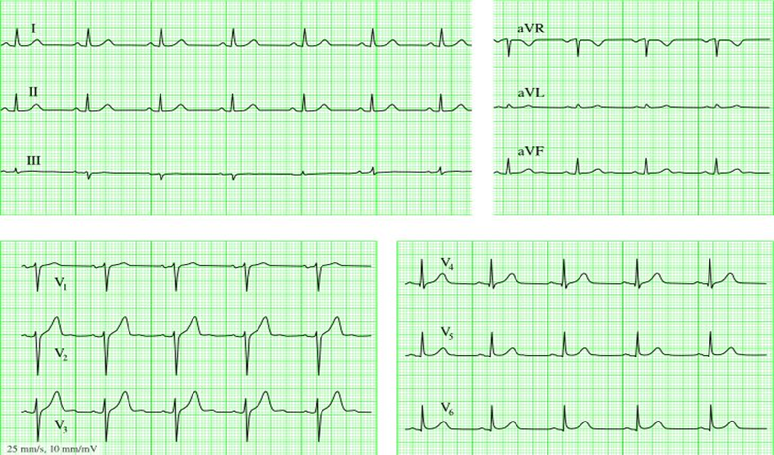 Как выглядит нормальная. Нормальный ЭКГ здорового человека. Нормальная кардиограмма сердца. Как выглядит ЭКГ В норме. Нормальное ЭКГ 25 мм.
