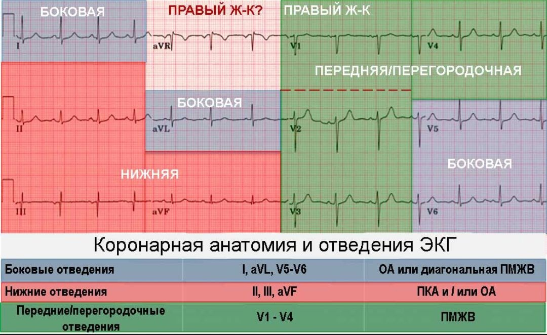 Подъем st в avl. Инфаркт миокарда передней стенки ЭКГ. Инфаркт миокарда латеральной стенки ЭКГ. Инфаркт передне боковой локализации ЭКГ. Отведения на ЭКГ И локализация инфаркта.